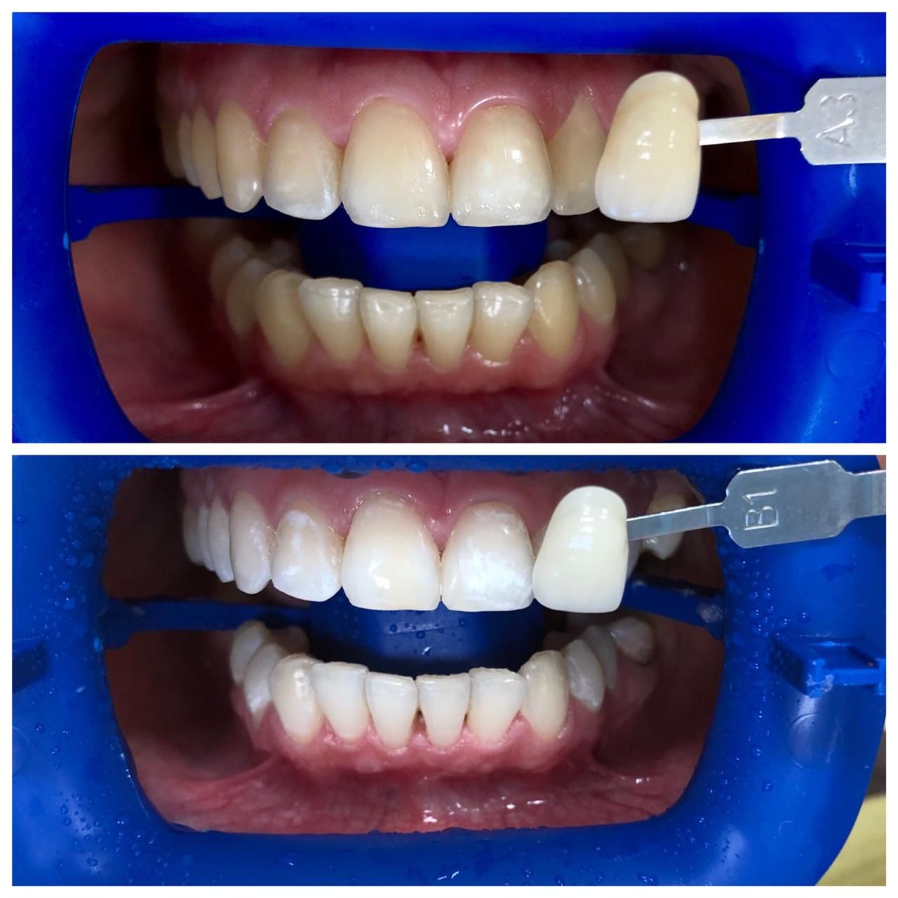 Отбеливание зубов до и после