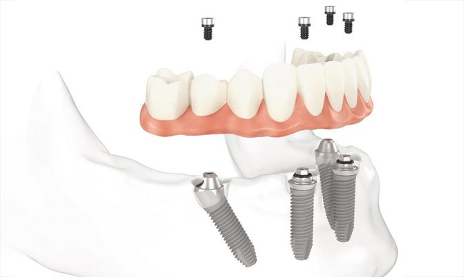 протезирование зубов на имплантах казань